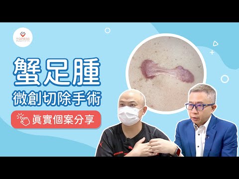 【手術室直擊】蟹足腫微創切除手術｜患者真實個案分享｜高壓氧如何幫助傷口修復？｜最強生命線