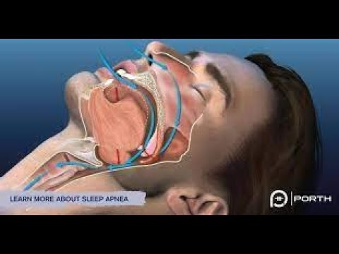 OSA / Obstructive Sleep Apnea