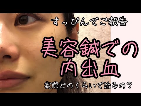 内出血がどのくらいで治るのか知りたい人は参考になるかも！？【鍼灸師＊Biancaなざと】