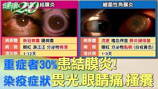 重症者30%患結膜炎！染疫症狀畏光.眼睛痛.搔癢 健康2.0