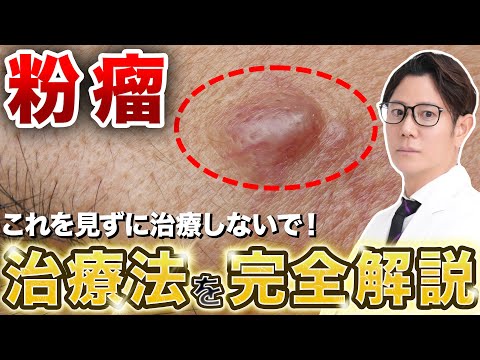 Causes and Treatment of Atheromas: Explained by a Japanese Dermatologist