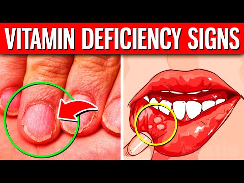 The 10 HIDDEN Signs Of Vitamin Deficiency You Should Never Ignore!