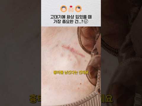 고데기에 화상 입었을 때 어떻게 대처해야 할까?｜화상치료, 흉터관리