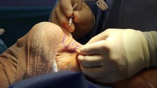 Microstab Phlebectomy // Painful Varicose Vein Removal