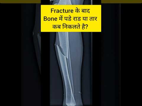 Fracture ke baad bone se wire kab nikalte hai?#orthopedics