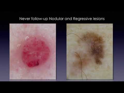 Changing lesions during follow-up - Dr. Elvira Moscarella