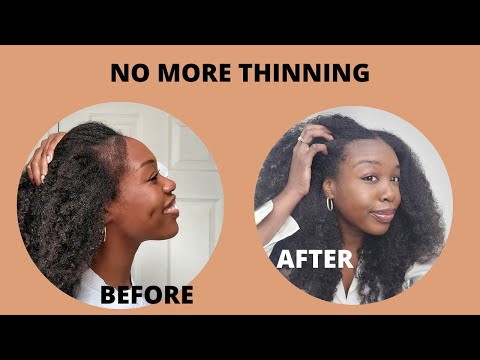 How I Grew Back My Temples | Natural Hair Thinning