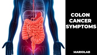 Colon Cancer Warning Signs You Should Never Ignore!