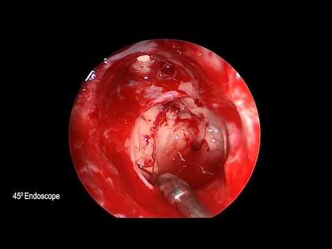 Endoscopic endonasal resection of a clival chordoma with massive brainstem compression