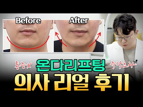 리프팅레이저 온다리프팅! 얼굴에 직접 시술한 후기!