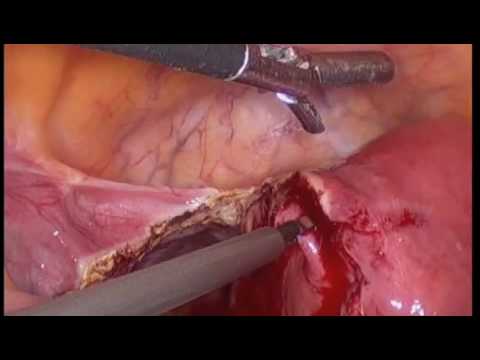 Laparoscopic Hysterectomy for Large Cervical Fibroid Dr Rooma Sinha, Hyderabad.m4v