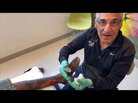 Real Wound Care: Chronic Malleolar Wound