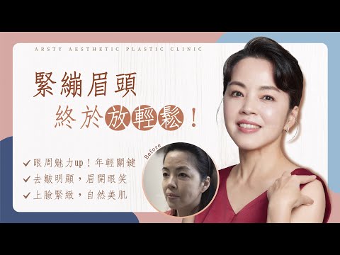 【內視鏡提眉、割雙眼皮】 熟齡美人一站式眼周逆齡年輕化效果分享 | 璞美整形外科醫美診所