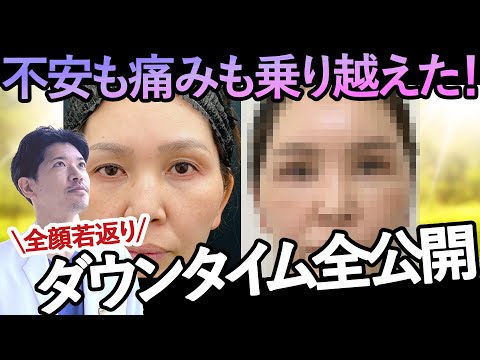 全顔脂肪注入のダウンタイムを全て公開します！40代後半女性、全顔若返り整形⭐︎