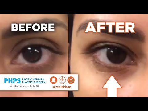 DARK CIRCLES! Undereye Treatment - Patient Perspective | Pacific Heights Plastic Surgery – Dr Bae!