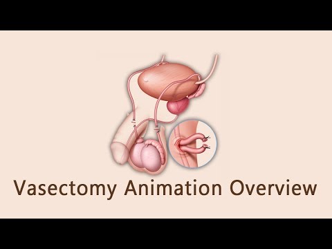 Vasectomy Animation Overview