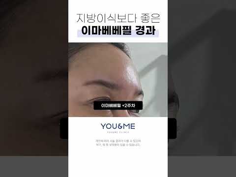 이마필러 진짜 잘하는 곳 찾고 있으시죠?