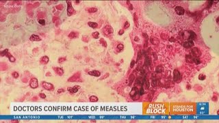 Boy hospitalized tests positive for measles in Houston