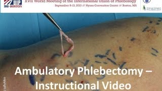 Ambulatory Phlebectomy Instructional Video