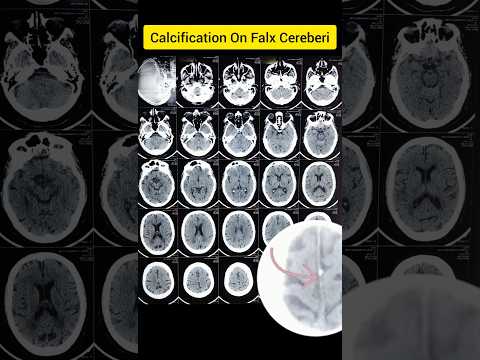 Calcification On Falx Cereberi