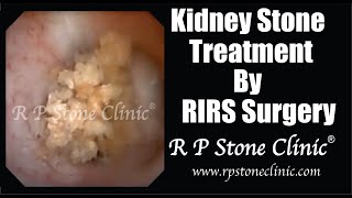 Kidney Stone Treatment by RIRS Surgery