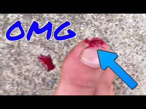 WORST STUBBED TOE EVER!! **graphic warning** (insane)