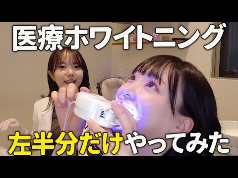 【医療ホワイトニング】左半分だけやってみたら大変なことになりました...！