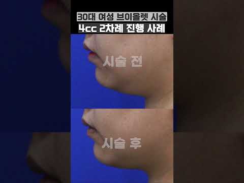 브이올렛 주사 시술 4cc, 2차례 진행한 이중턱 개선 사례