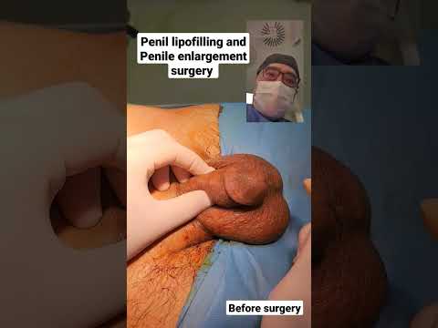 Penil lipofilling and Penile enlargement surgery before surgery Dr Araz Bayramov #penis #penile