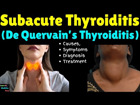 Subacute Thyroiditis (De Quervain’s Thyroiditis) – Causes, Symptoms, Diagnosis and Treatment