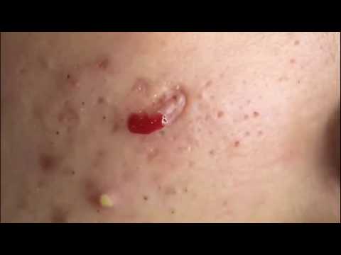 Deep Blackheads Acne Removal from Cheeks and Nose, Milia, Skill Acne Remove