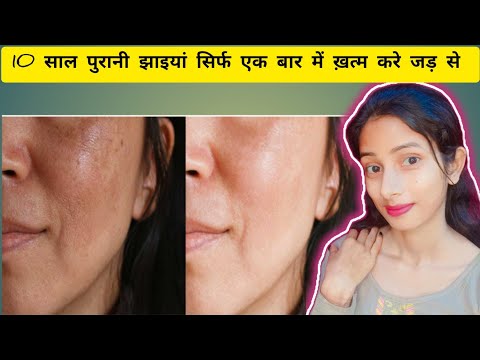 10 साल पुरानी झाइयां सिर्फ एक बार में ख़त्म करे जड़ से ||  चेहरे की झाइयां, Melasma जड़ से खत्म करें