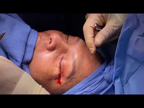 FULL BLEPHAROPLASTY EYELID SURGERY in the Operating Room!