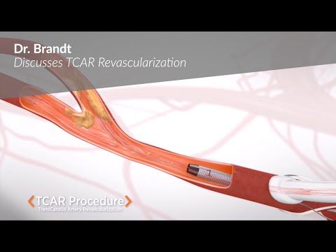 Dr. Brandt discusses TCAR Revascularization