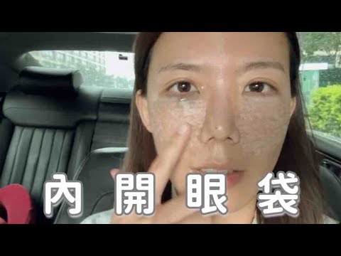 內開眼袋＋淚溝回填分享、台灣的醫美技術不要太好了吧！