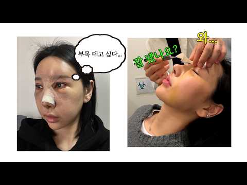 첫 코성형인데... 재료? 높이? 부작용? [소피Vlog]