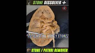 Kidney Stone Relief Begins with Stone Dissolver | THE YOGA MAN LAB