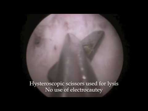 Asherman Syndrome (intrauterine adhesions) hysteroscopy lysis scissors Dr Rooma Sinha, Hyderabad