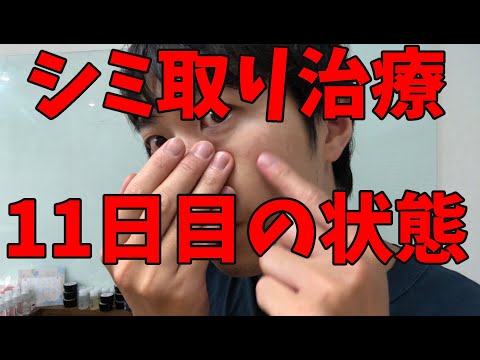 シミ取りレーザー経過報告　11日目の状態と、今後の治療を解説