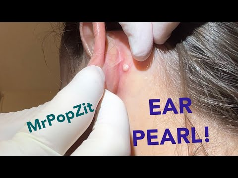 Follicular cyst removal. I find a gem behind the ear and extract it.