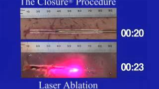 Laser Ablation vs Radiofrequency Ablation