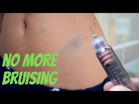 Stop Insulin Injection Bruising with These 6 Tried Tips