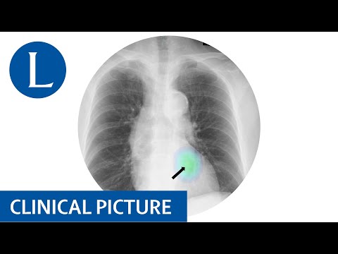 Now you don’t see it, now AI does: AI spots lesion on chest x-ray