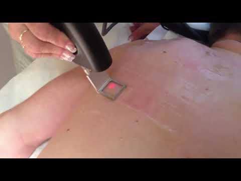 Laser Treatment - Hair Removal by MedArt VariMed System