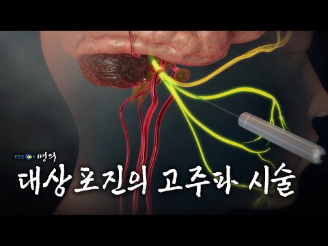 [명의 의학백과📖] 대상포진의 고주파 시술