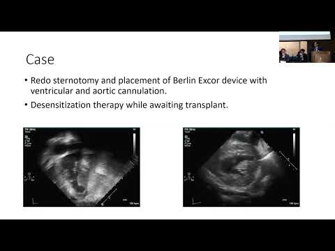 Mechanical Circulatory Support in the Single Ventricle Patient - Ming Sing Si, MD