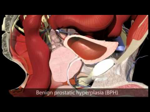 Prostate Health - What is Prostate Enlargement (BPH)?