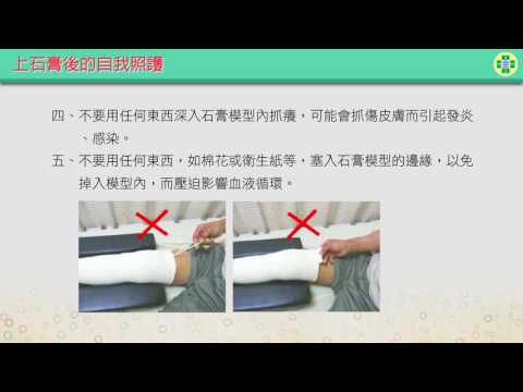 上石膏後的自我照護-台語版