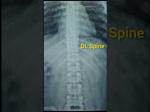 DL Spine X ray