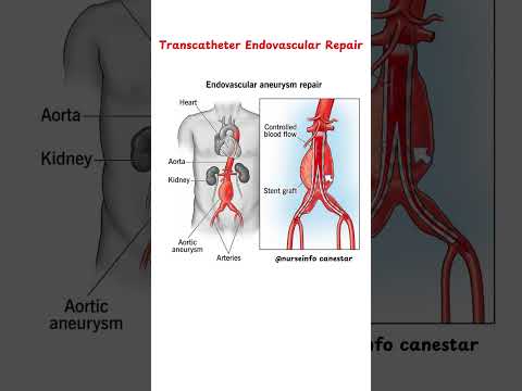 Transcatheter Endovascular Repair Procedure - Aorta #endovascularrepair rajinikanth